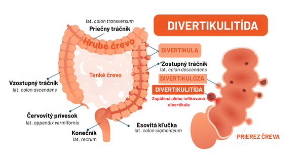 Divertikulitída: Keď v čreve vznikne neželaný zápal.